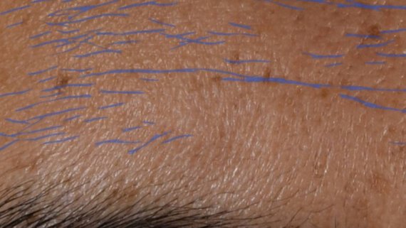 forehead wrinkles on man