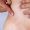 Vergetures sur un homme