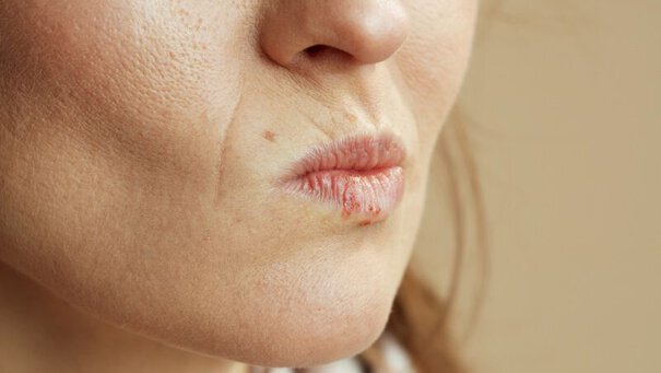 Damaged woman lips