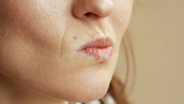 Damaged woman lips